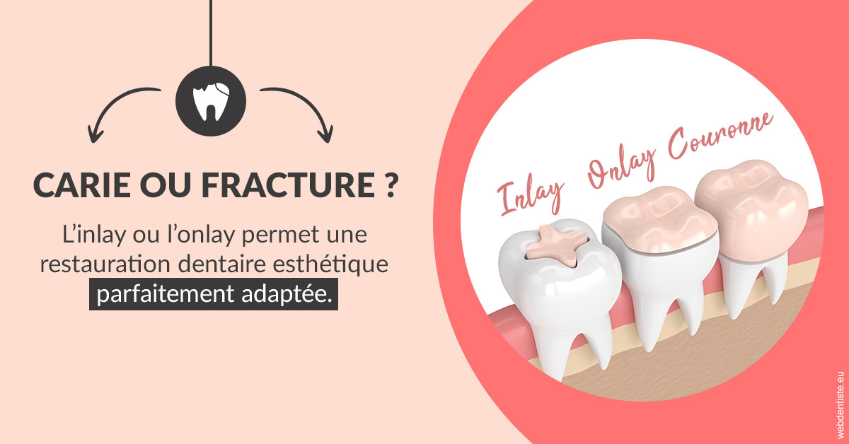 https://dr-emilie-lacaze.chirurgiens-dentistes.fr/T2 2023 - Carie ou fracture 2