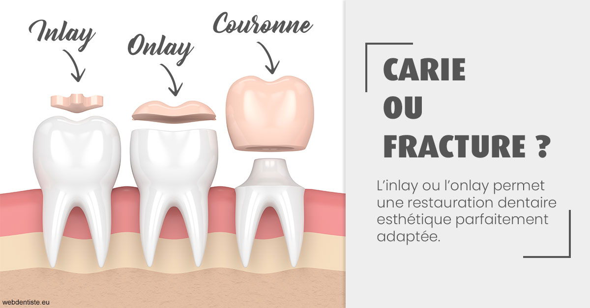 https://dr-emilie-lacaze.chirurgiens-dentistes.fr/T2 2023 - Carie ou fracture 1
