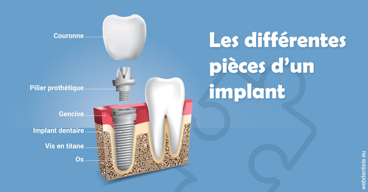 https://dr-emilie-lacaze.chirurgiens-dentistes.fr/Les différentes pièces d’un implant 1